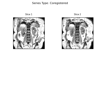 Series Type: Coregistered    , Slice 1, Slice 2
